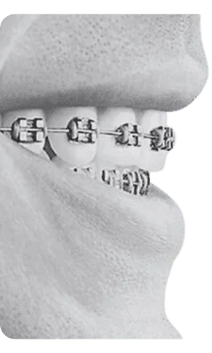 sem invisalign