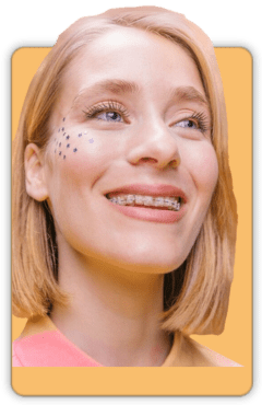 APARELHO CERAMICA aparelho dentario