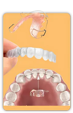 APARELHO CONTENÇAO aparelho dentario