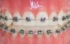 BOCA AUTO METALICO aparelho dentario