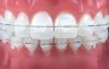 BOCA CERAMICA APARELHO DENTARIO