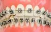 boca aparelho metalico - - aparelho dentário