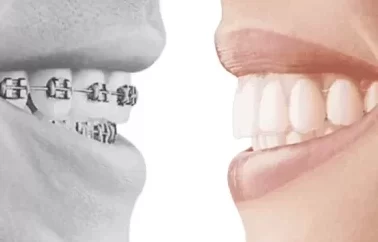 imagem antes e depois invisalign