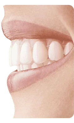 com invisalign